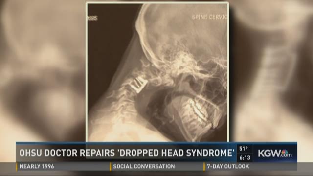 Ohsu Doctor Repairs Dropped Head Syndrome